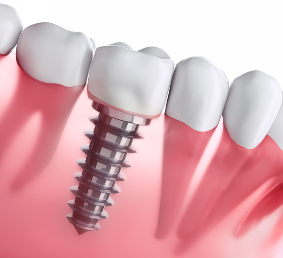 dental implants in se calgary