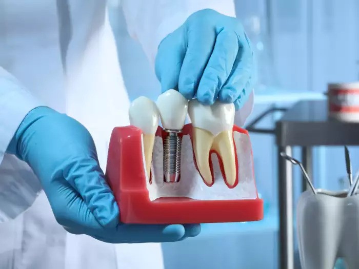 what are the advantages of implants over tooth replacement options