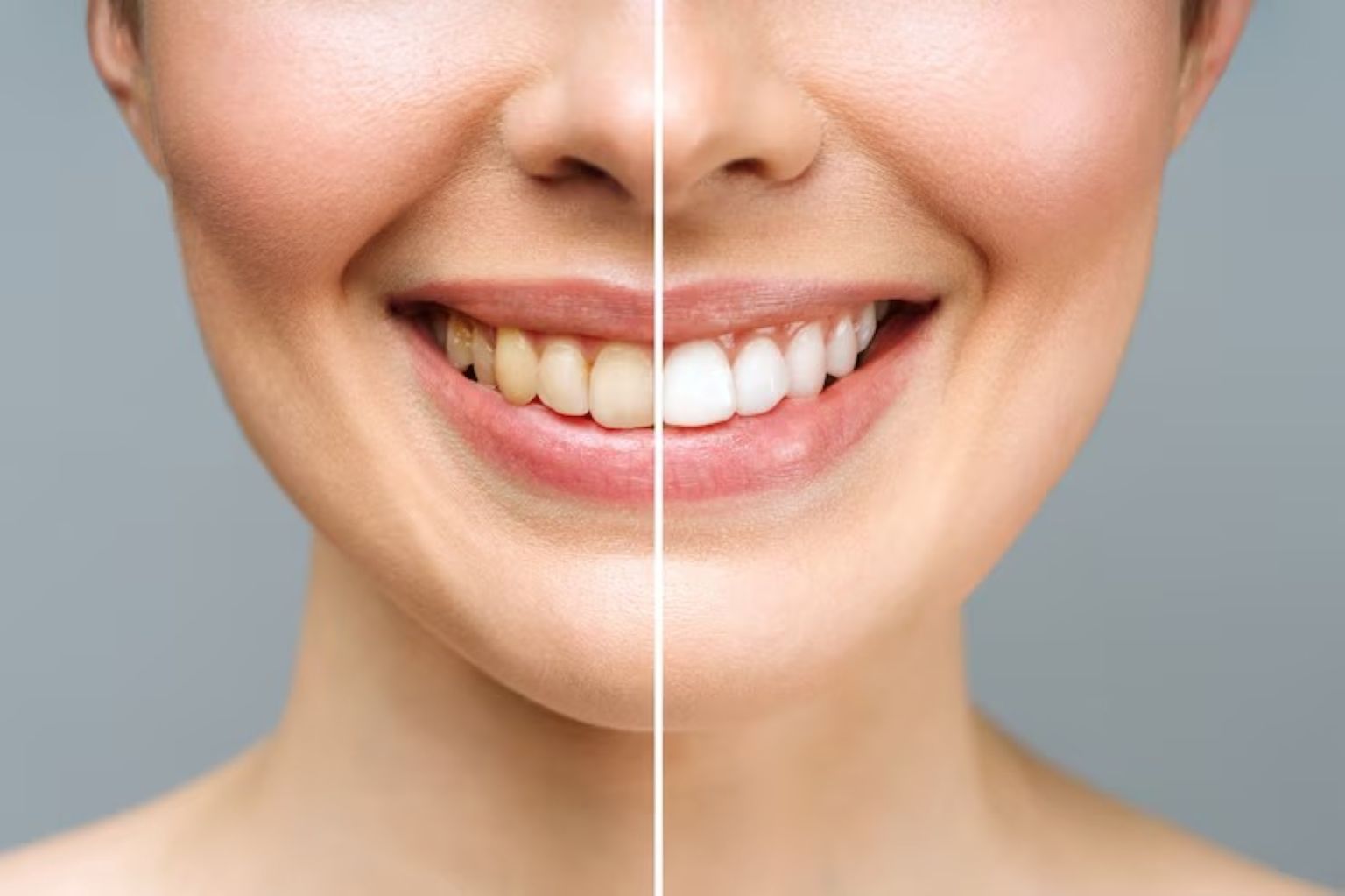 Whitening Options for Sensitive Teeth Explained