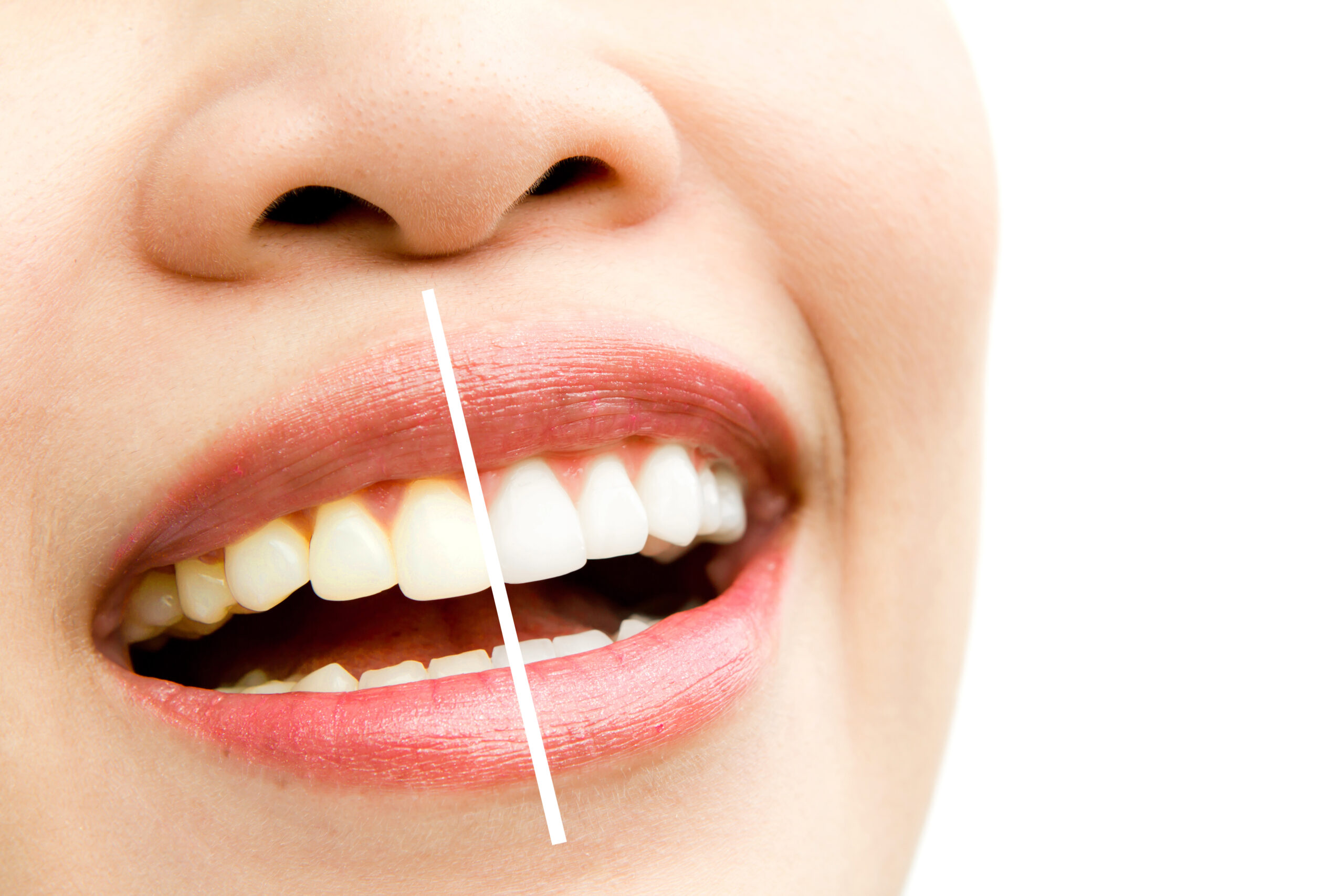 is-teeth-whitening-safe-and-effective-dentist-insights