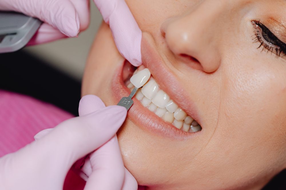dental veneers smile