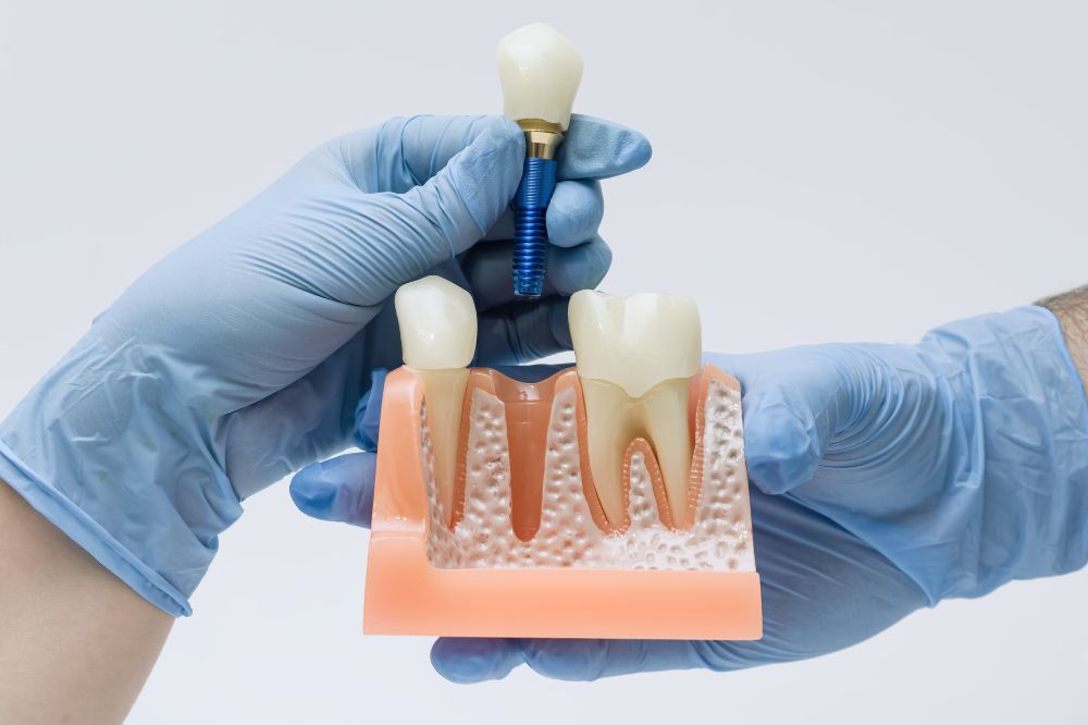 dental implant restoration