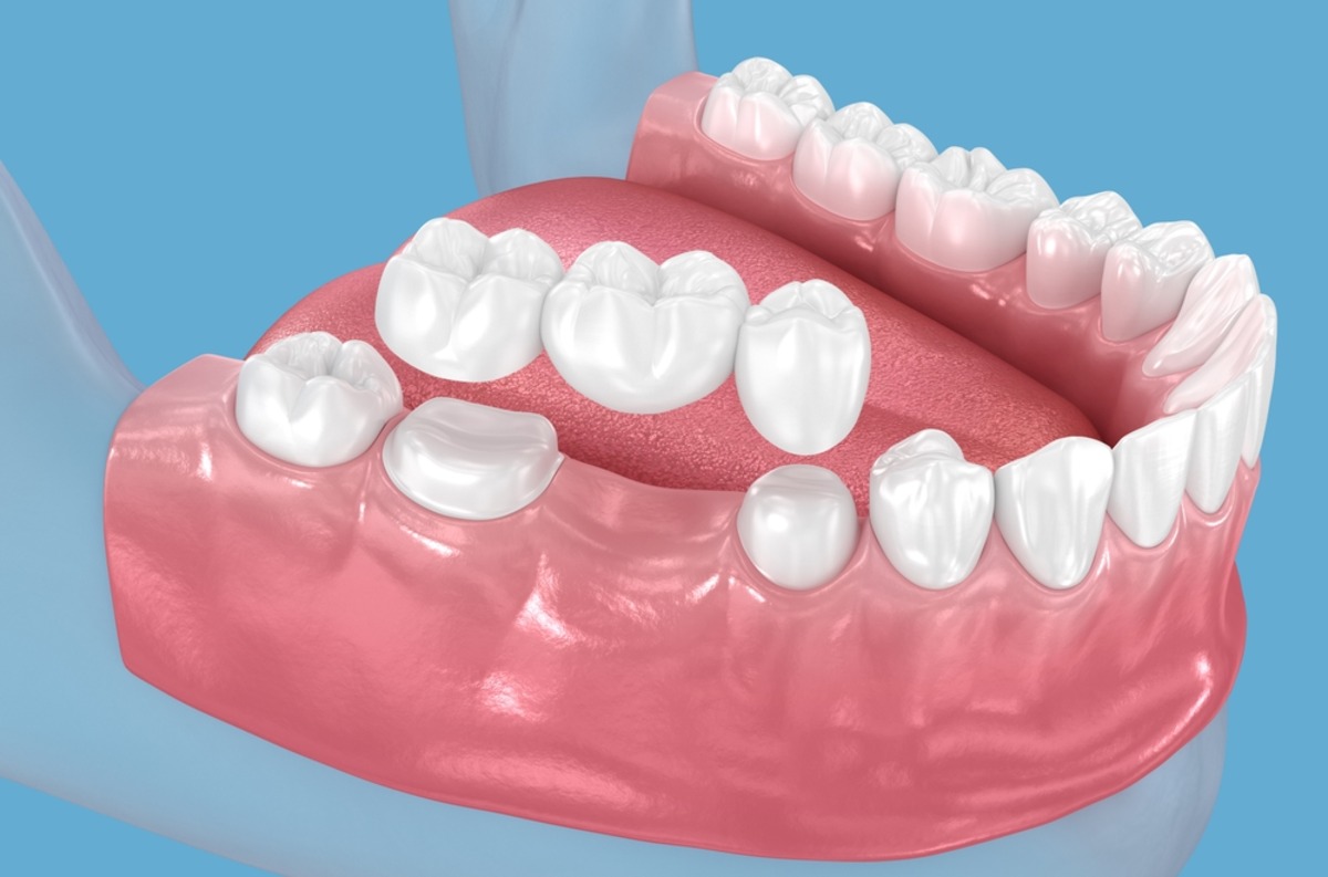 natural-looking dental bridges